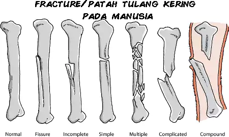 patah tulang atau fracture